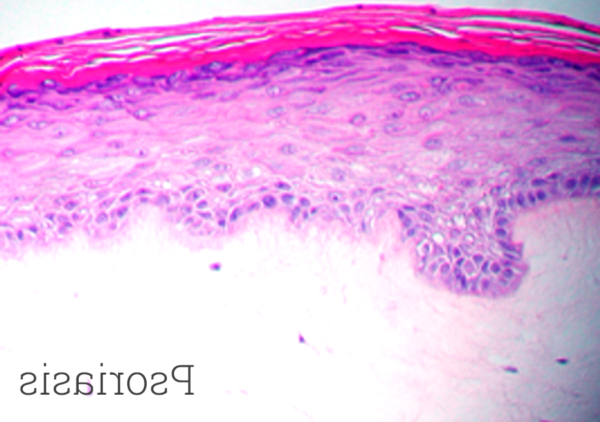 Psoriasis Histology New